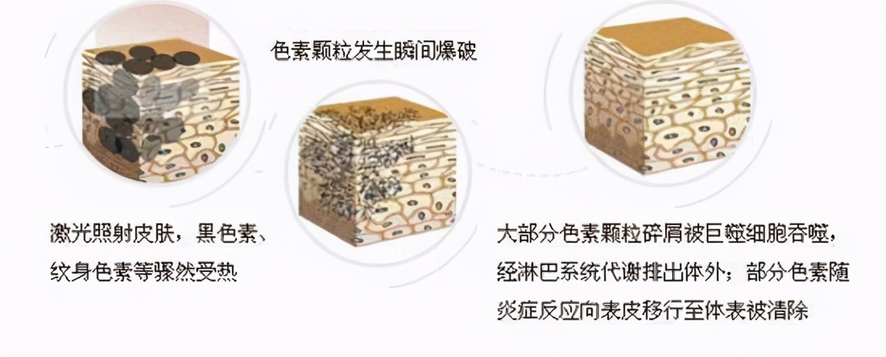 脸激光后色斑颜色很深怎么办,激光祛色斑多久可以用化妆品