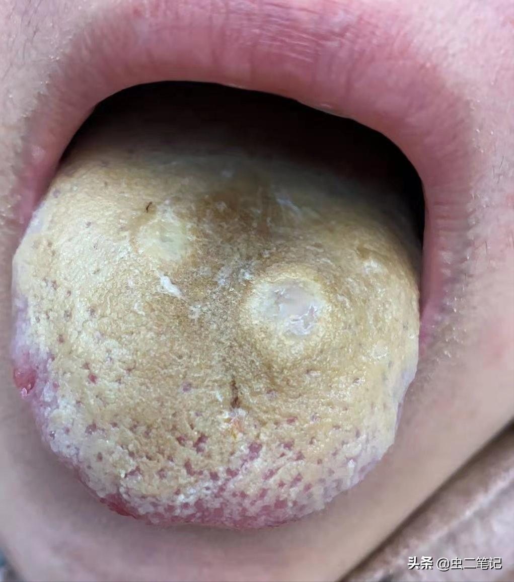 口舌生疮简单易行的小妙方,喉咙肿痛口舌生疮中医怎么看