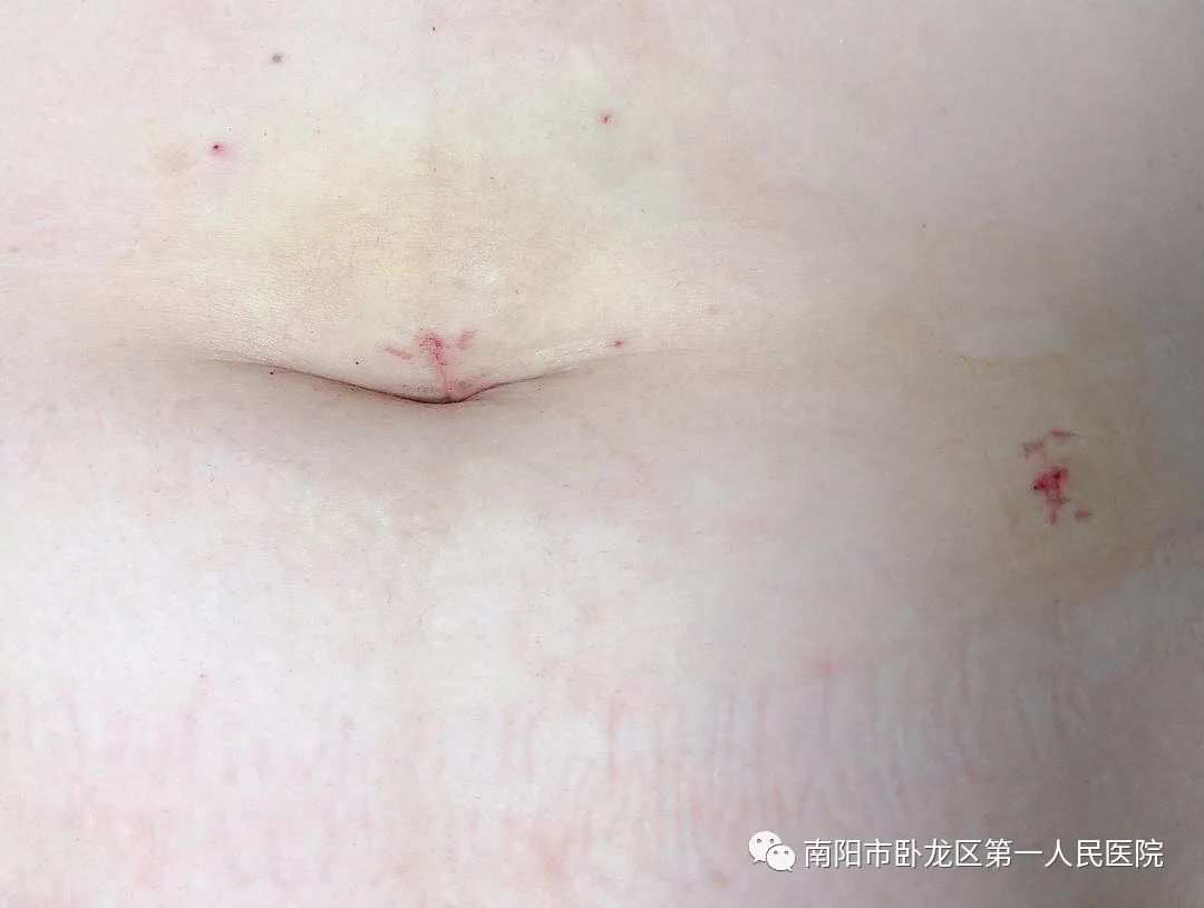 术后不留痕——卧龙区第一人民医院妇产科专家为您解答腹腔镜手术