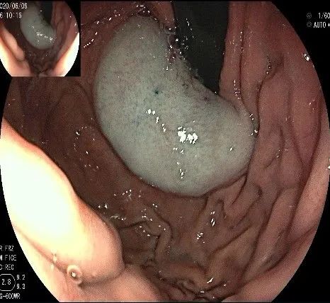 贲门处见隆起性病变,贲门高级别瘤变esd术后不能吃什么