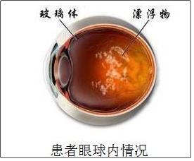 飞蚊症眼前有黑影原因,眼睛看到飞蚊症是怎么回事