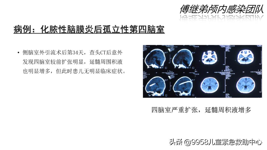 颅内感染康复治疗知识,小儿颅内感染的健康宣教