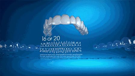 牙齿矫正必须先拔掉智齿嘛,牙齿矫正一定要先补牙吗