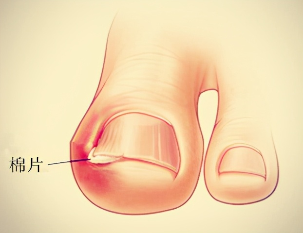 甲沟炎的处理方法视频,甲沟炎处理小视频