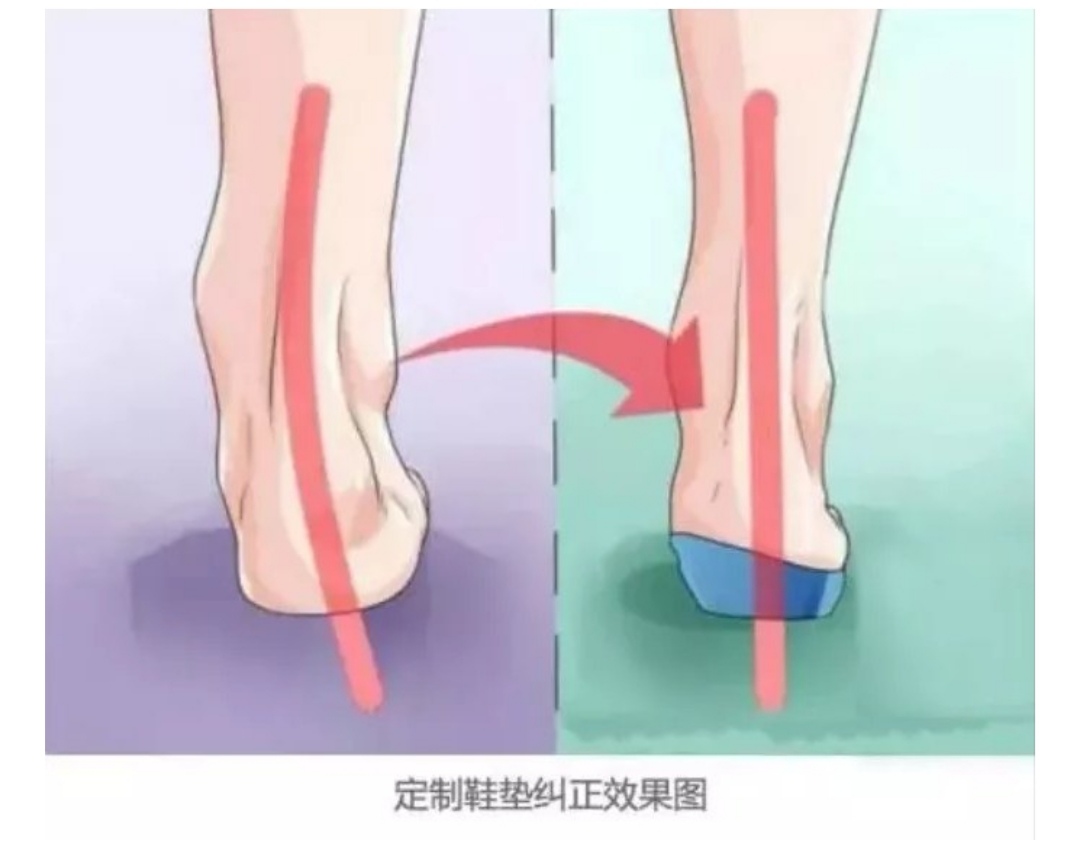 扁平足治疗手术费用,扁平足儿童专用鞋