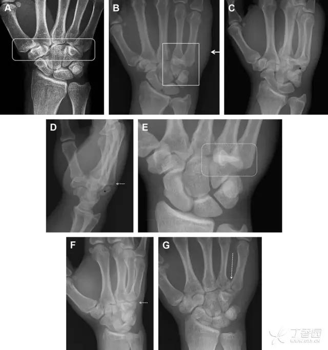 放射科夜班病例大全,放射科容易漏诊的骨折