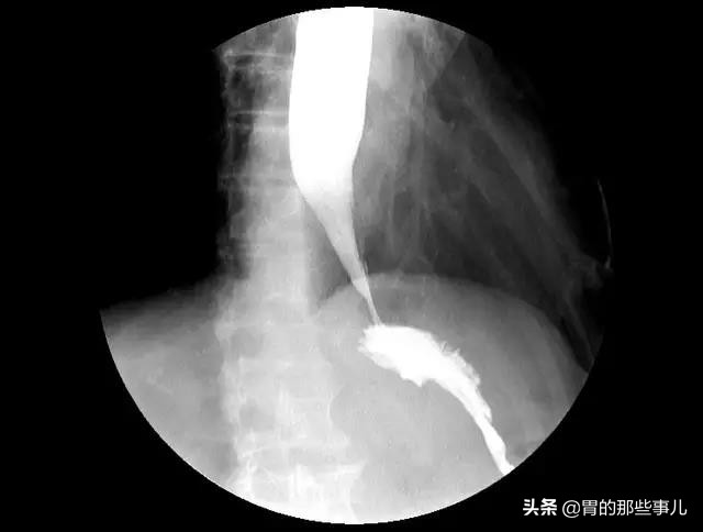 哮喘类似的病,胃性哮喘能治愈吗