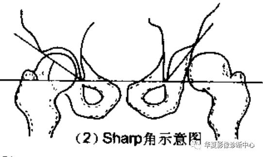 先天性髋关节脱位截骨术全过程,先天性髋关节脱位可以考驾驶证吗