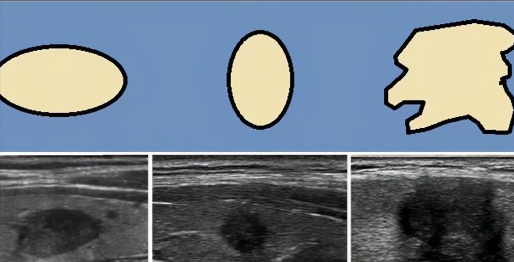 甲状腺b超片状低回声是什么意思,甲状腺b超回声不均匀意味什么