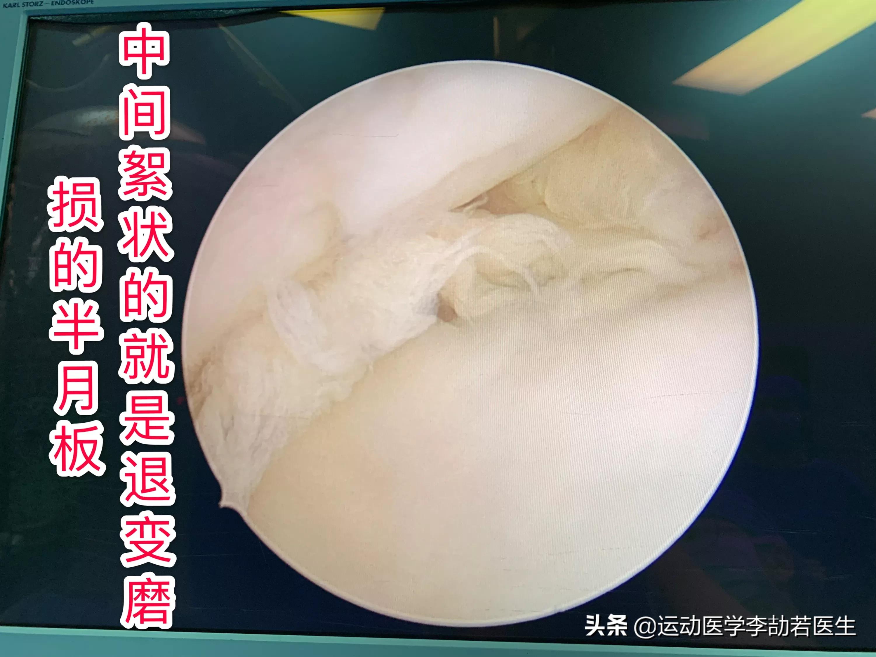 骨关节炎到底该怎么治,骨关节炎怎么治才能彻底治好