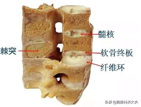 腰椎间盘突出最好的影像诊断方法,腰椎间盘突出的影像学检查