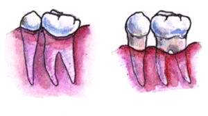 导致牙龈萎缩的4个原因,导致牙龈萎缩的4大原因