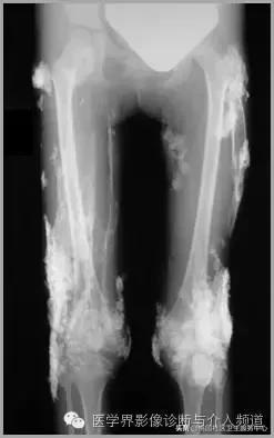 软组织钙化是不是骨化性肌炎,软组织钙化或骨化