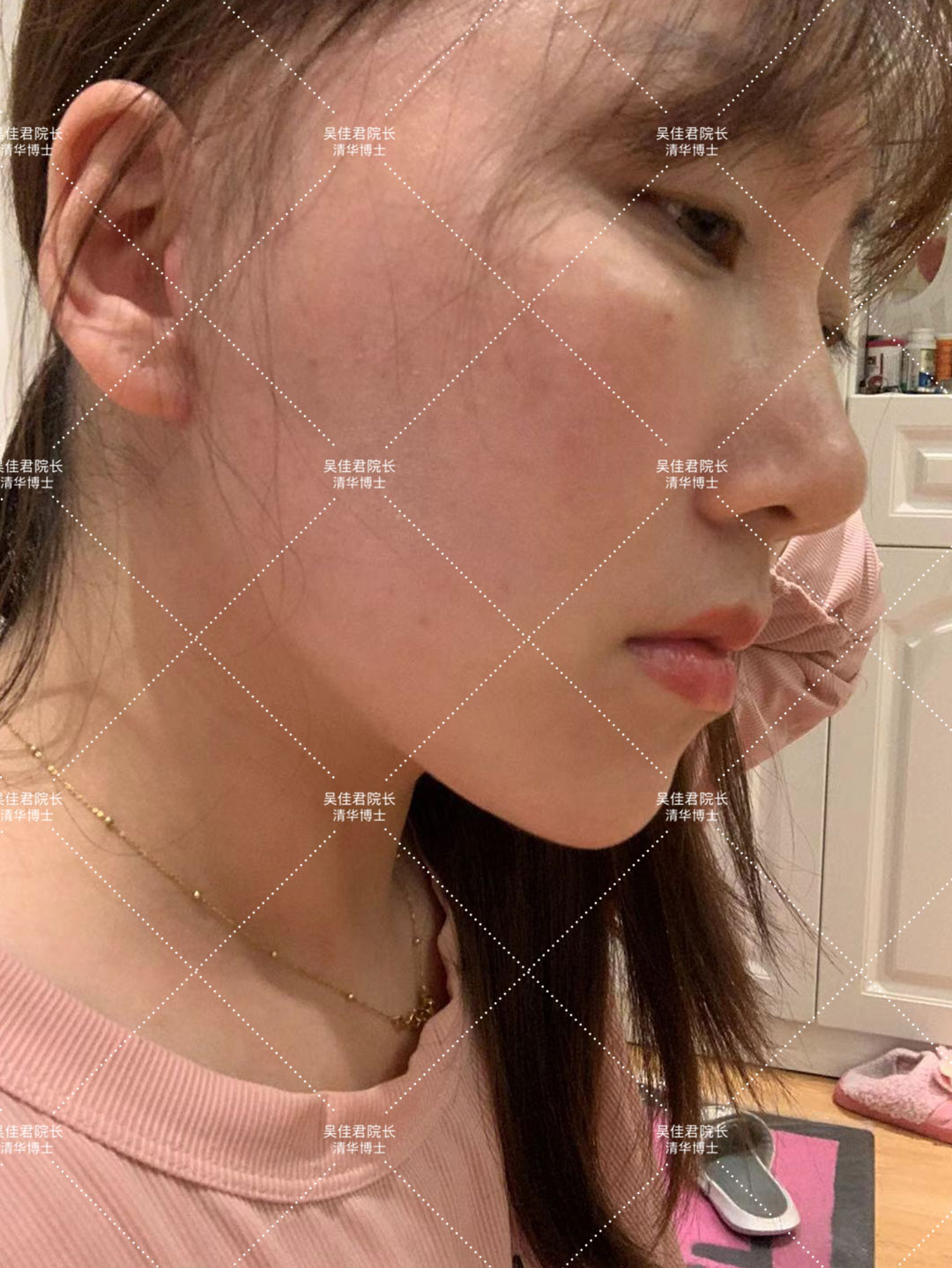 做一个拉皮手术人可以年轻多少岁,做拉皮的真实感受