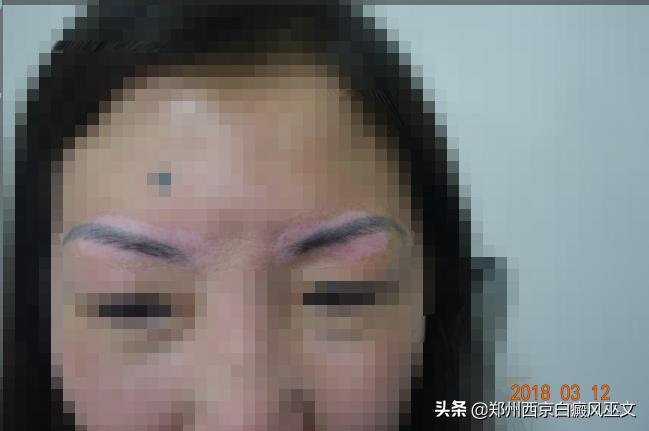 白癜风早期分型图,白癜风的病例描述