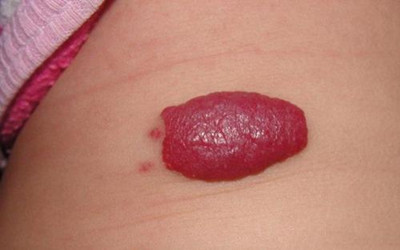 肝血管瘤多发严重吗需要注意什么,婴儿激光祛血管瘤注意事项