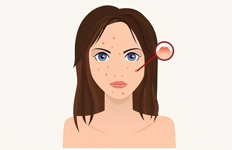 李医生扁平疣最简单的去除方法,一招帮你消除扁平疣