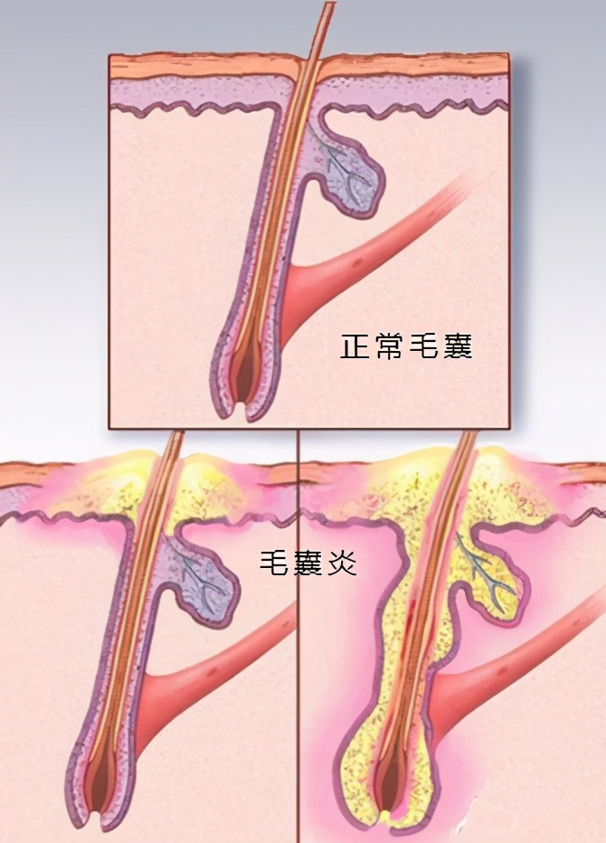 穿掘性毛囊炎喝中药多久能好,治疗穿掘性毛囊炎最好的医院