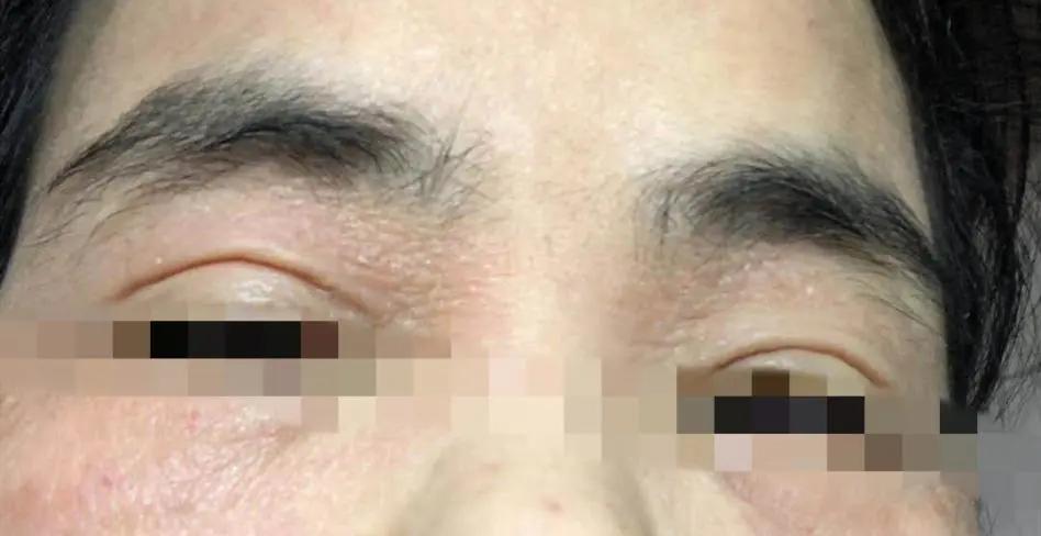 美容不成反毁容的案例,美容不做了皮肤会越来越差