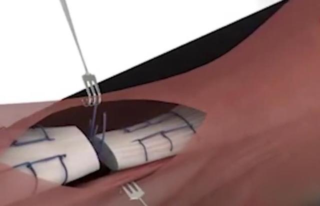医生把病人筋弄断了怎么办,病人断掉的筋是怎么接起来的