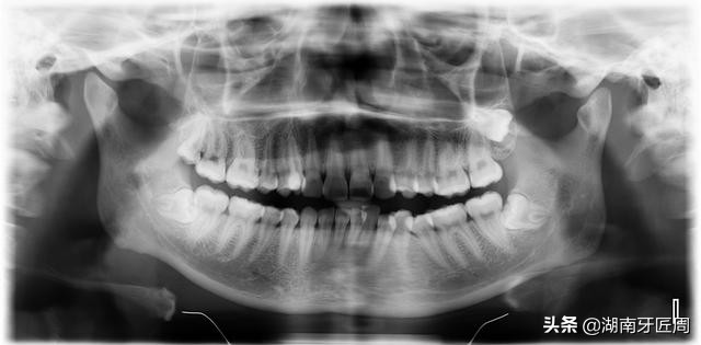 牙科拍片有多大危害？儿童和孕妇可以拍牙片吗？让牙匠周来捋一捋