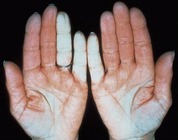 雷诺综合征的原因,雷诺综合症怎么得的