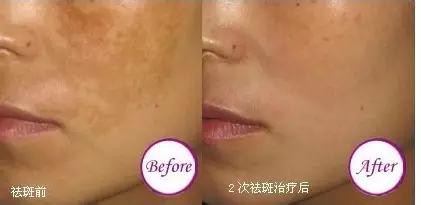 755激光祛斑和其他激光有什么区别,祛斑后反黑后可以再次激光祛斑吗