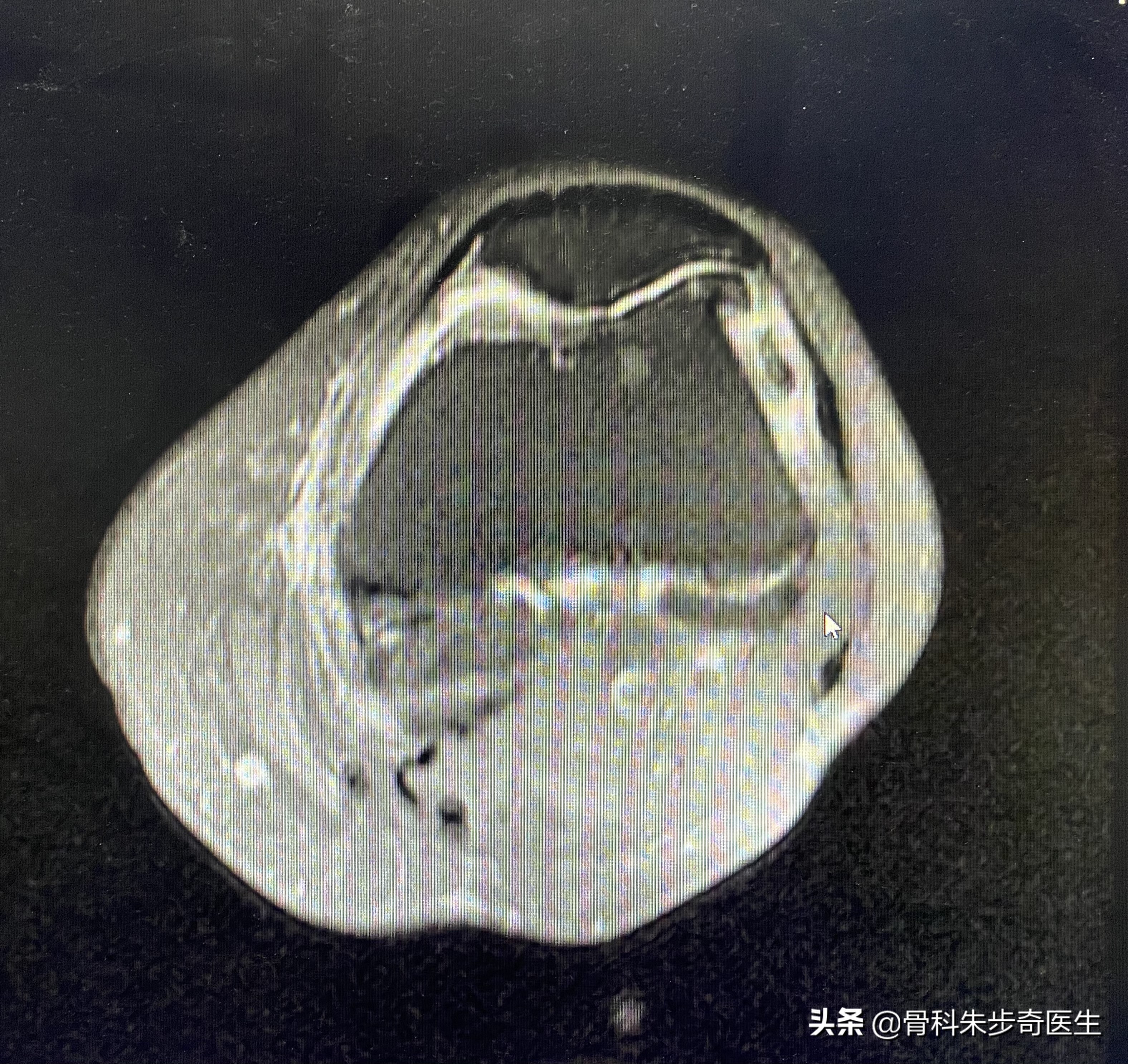 膝关节有骨刺应该怎么治,早期膝关节有骨刺怎么能治愈