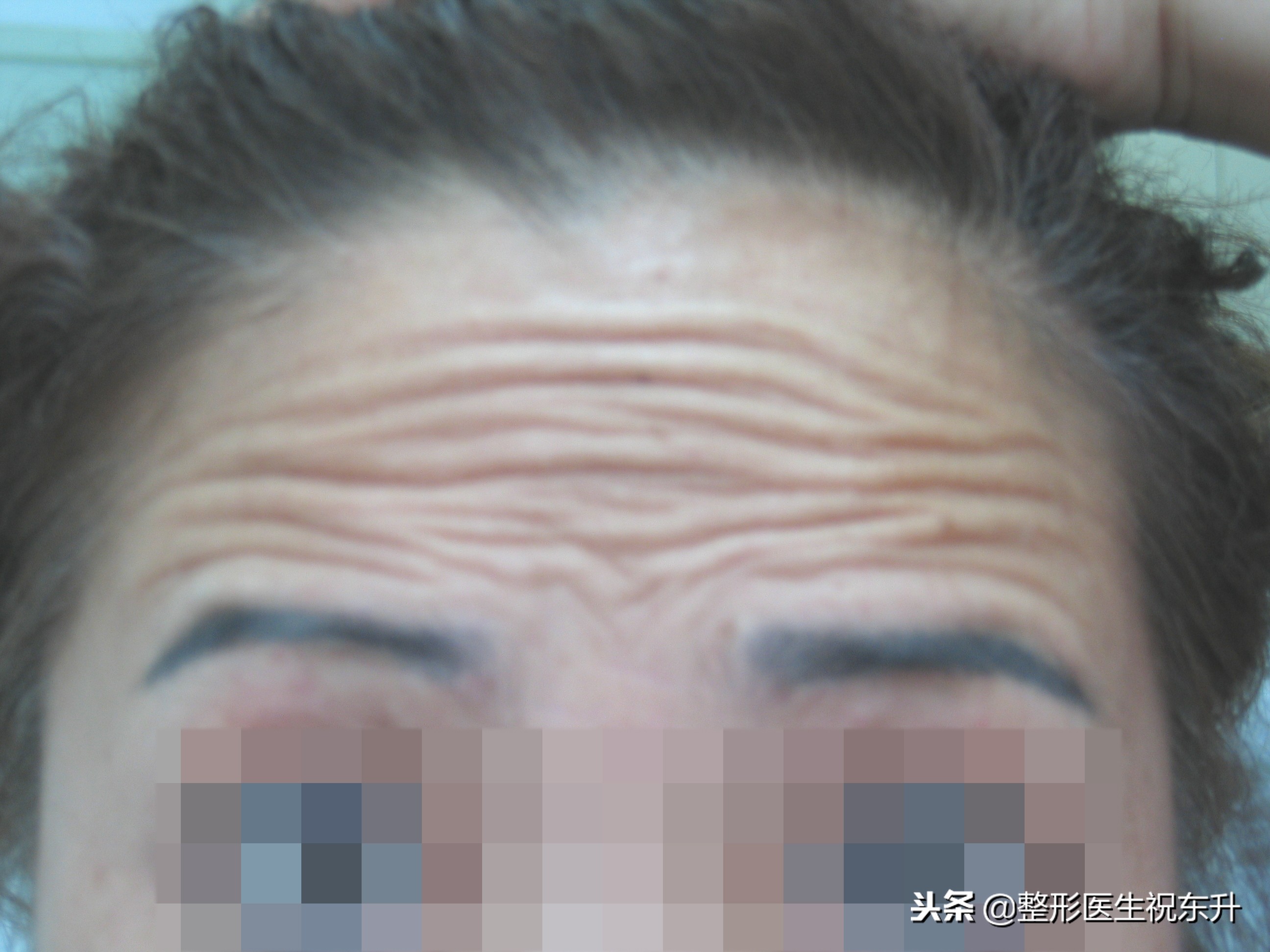 额颞部除皱去抬头纹怎么样,拉皮除皱抬头纹全过程视频