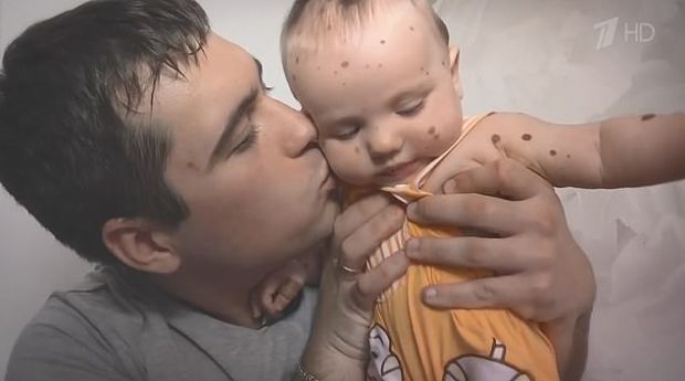 俄罗斯小孩背长满胎记,俄罗斯婴儿被告知死亡