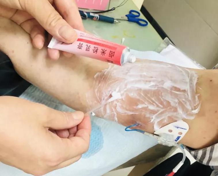 picc置管敷贴皮肤痒如何处理,picc置管防过敏贴膜进口