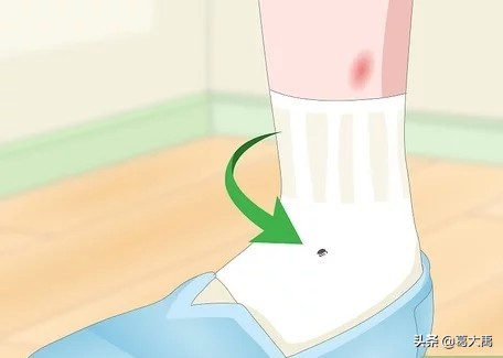 夏季如何辩认跳蚤的咬痕