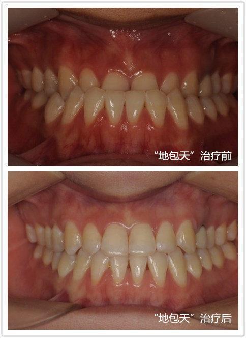 孩子牙齿不齐需要矫正吗,孩子牙齿不齐矫正有必要吗