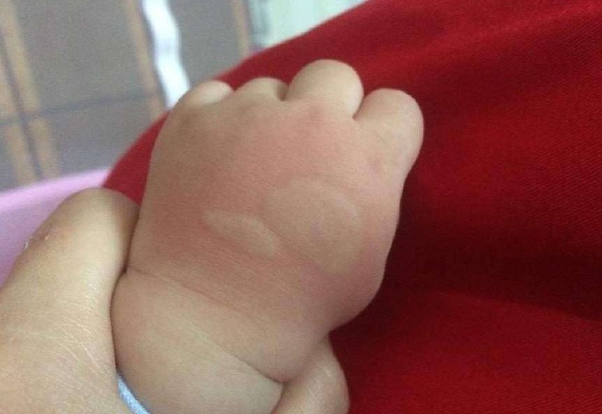 宝宝被蚊虫叮咬如何快速止痒消肿,宝宝被蚊虫叮咬后起大包怎么弄