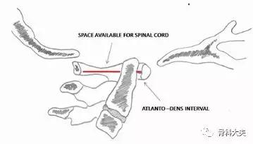 脖子突然往一边歪是怎么回事,孩子脖子突然歪了怎样矫正