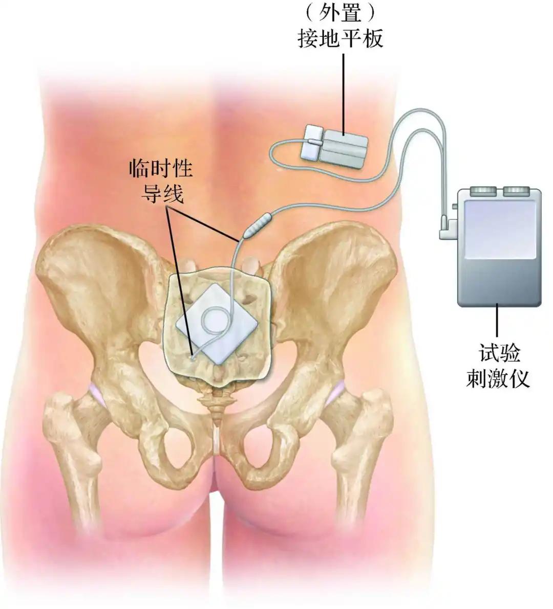 直肠癌保肛术后排大便困难怎么办,直肠癌保肛手术大便失禁怎么办