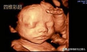 四维检查是好的但生下宝宝脚内翻,四维彩超通过后胎儿还会畸形吗