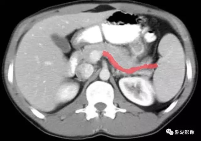 颈部胸锁乳突肌ct断层解剖图,骨盆骨质正常断层ct解剖图解