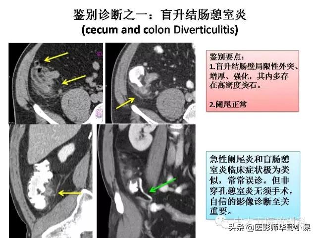 阑尾炎课件,阑尾炎的超声课件