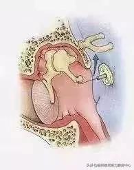 耳硬化症通过什么检查,耳硬化症的诊疗计划