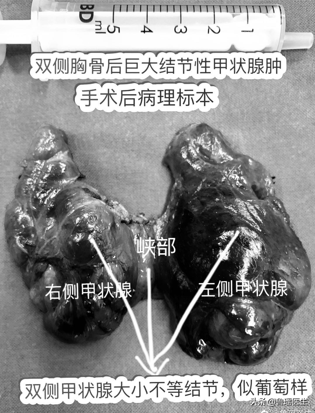 甲状腺结节从生长到发现要多久,甲状腺结节观察3个月会变大吗
