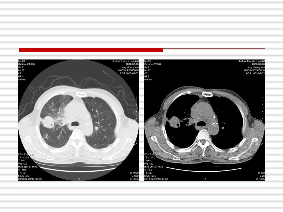 像炎症的肺癌能治好吗,医生说可能是肺癌也可能是炎症