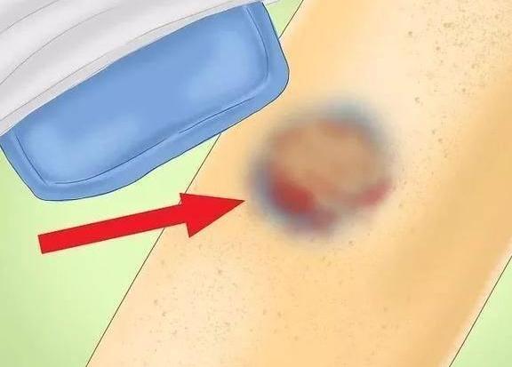 怀孕身上出现淤青是怎么回事,怀孕期间胳膊出现淤青是怎么回事