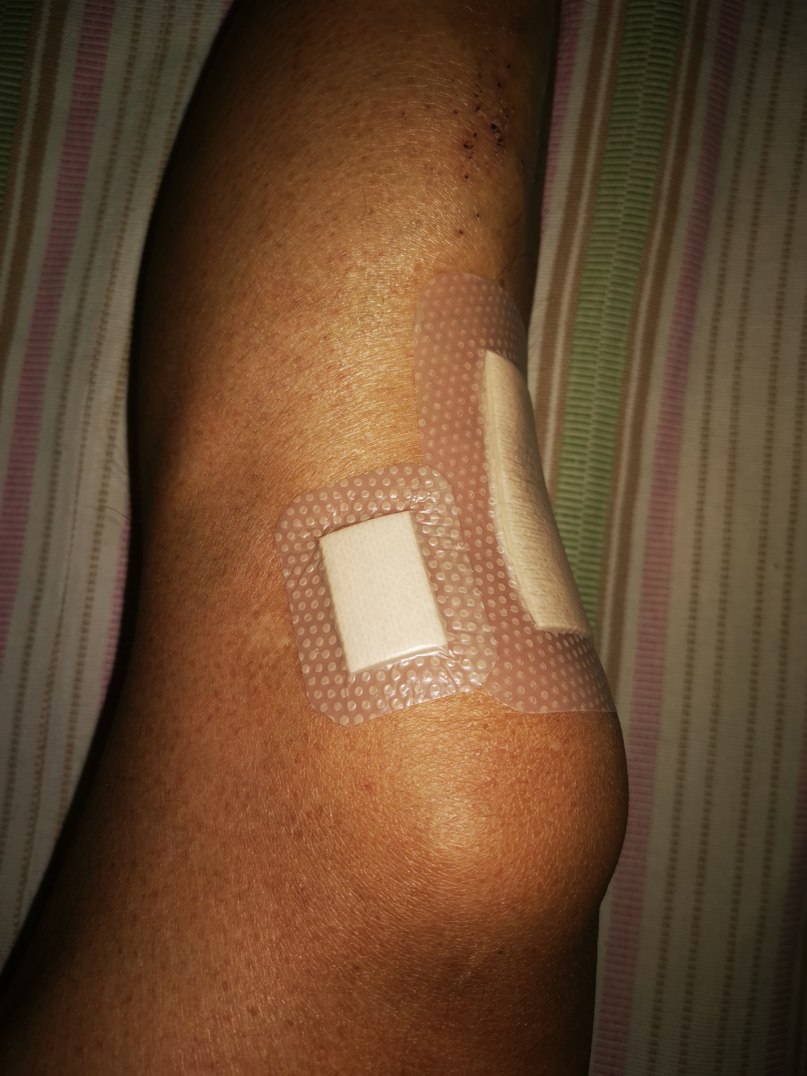 瑞典墨尼克敷料,瑞典墨尼克美皮护疤痕贴有效吗