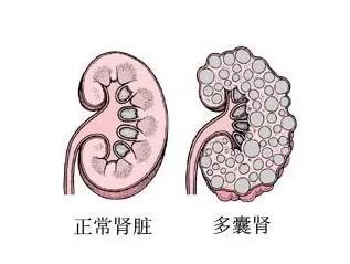 巨大肝囊肿怎么办,肝囊肿大了怎样做微创术