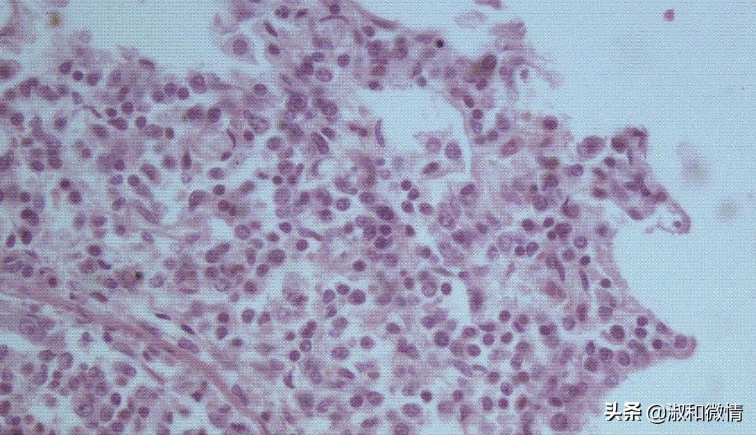 甲硝唑片的说明书用量看不懂,甲硝唑片的适应证有哪些