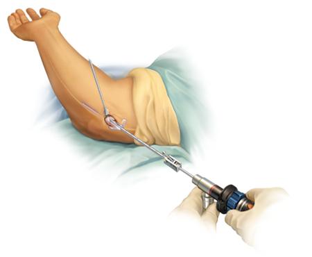 胳膊肘弯曲伸不直有10多年怎么办,胳膊肘转动但是不动