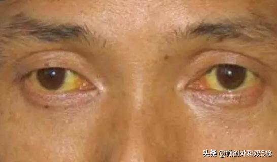 有乙肝大三阳经常喝酒会怎么样,乙肝大三阳经常喝酒会怎么样