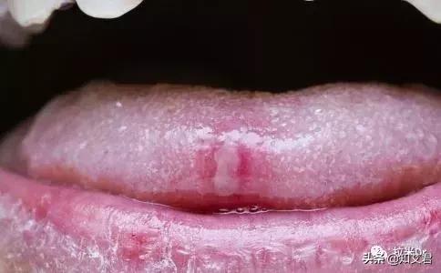 艾滋病患者最易发生的4种真菌感染，其中两种致命性非常高