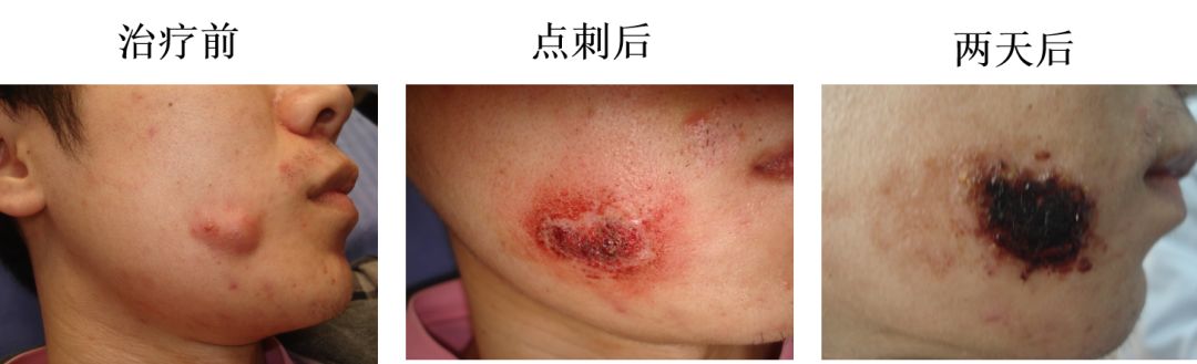 中医火针疗法教学视频,火针操作手法